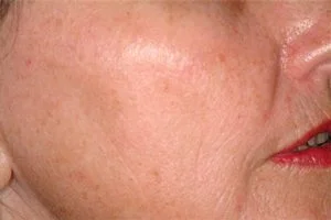 Laser-skin-resurface-treatment-after2-wr