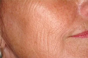 Laser-skin-resurface-treatment-before2-wr