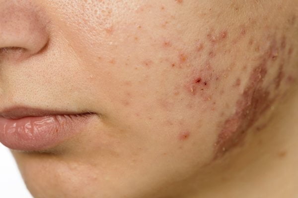 Best acne scar treatment