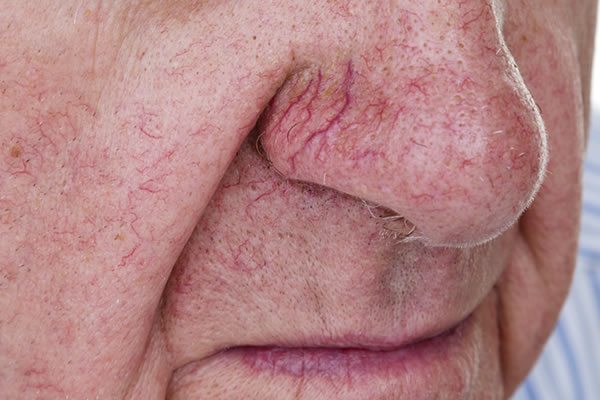 thread veins on nose