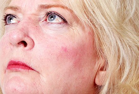IPL Rosacea treatment