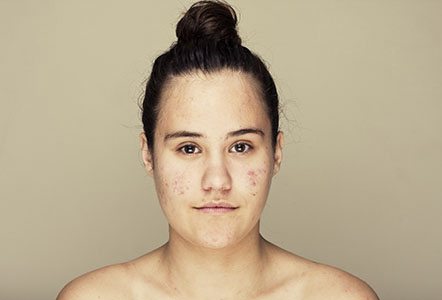 Best Acne Clinic London