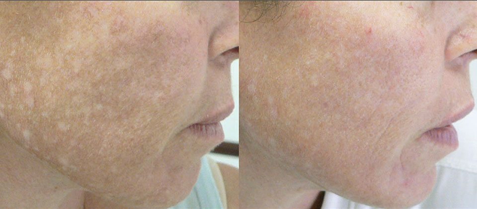 Before and after 1 treatment
