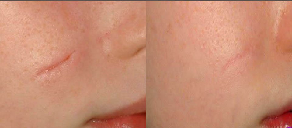 Before and after 7 treatments