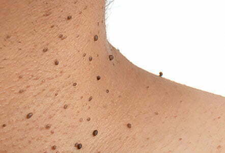 Close up the skin tags