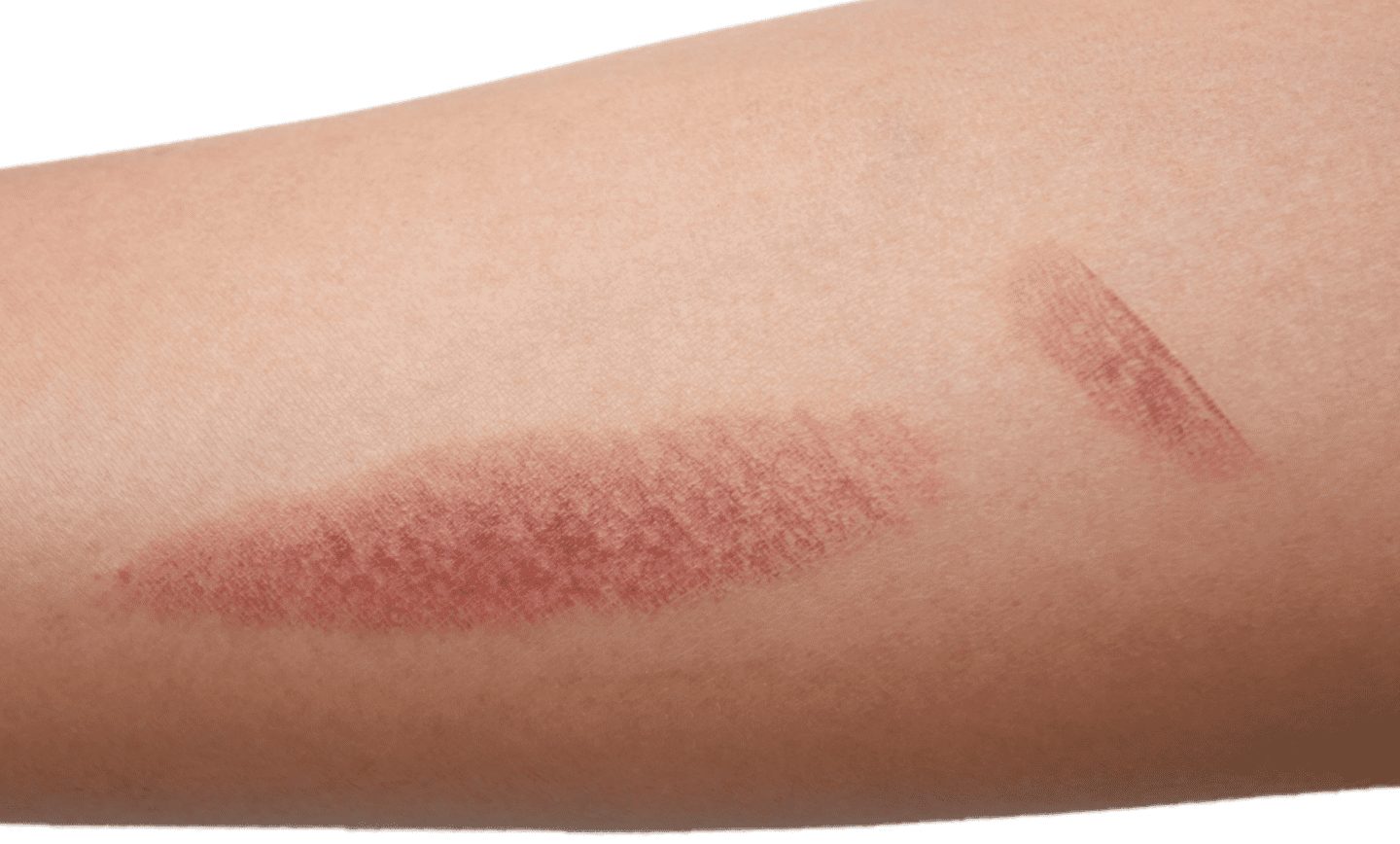Are laser hair removal burns common?