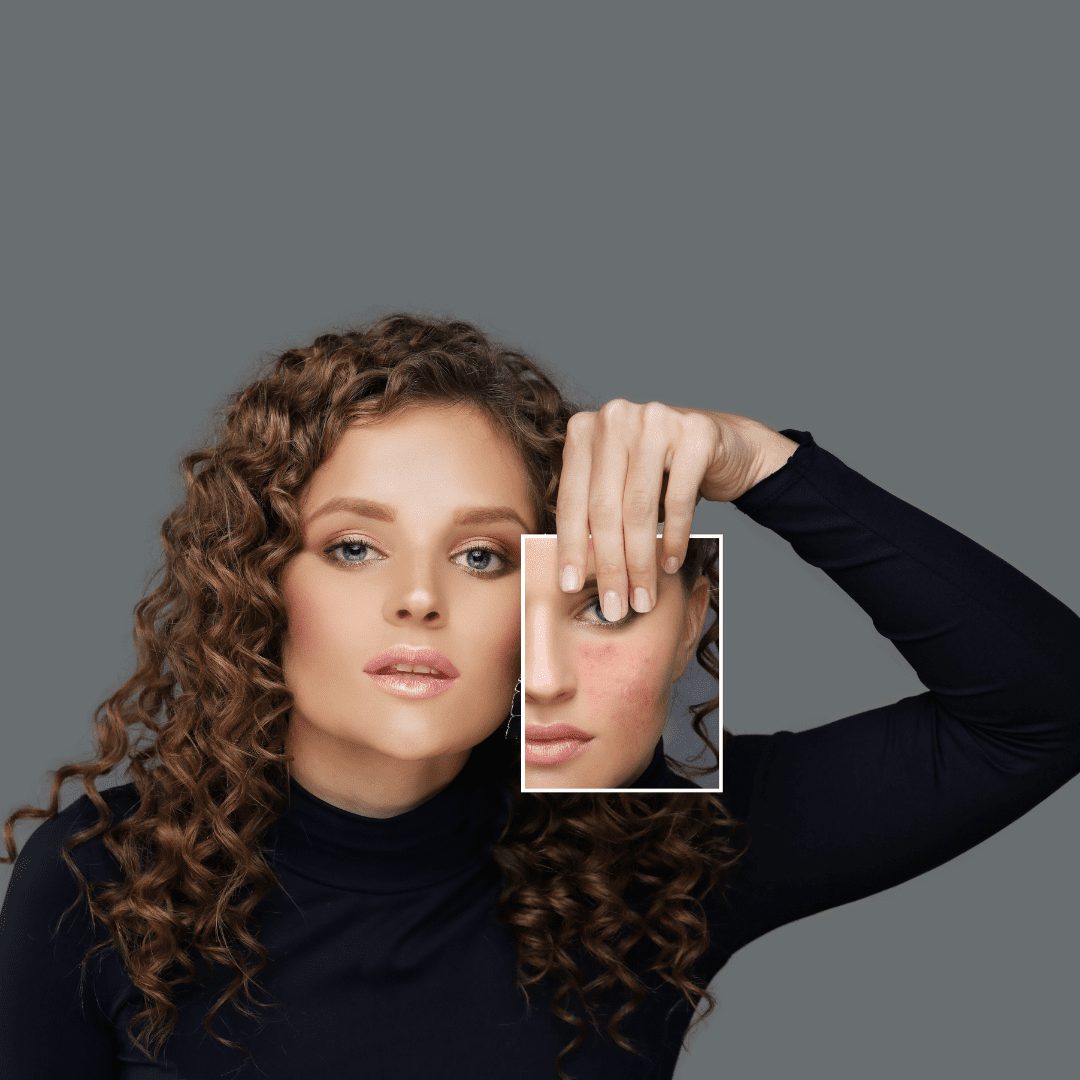 Can acne scars be removed? What are the treatment options and how to prevent future scarring?