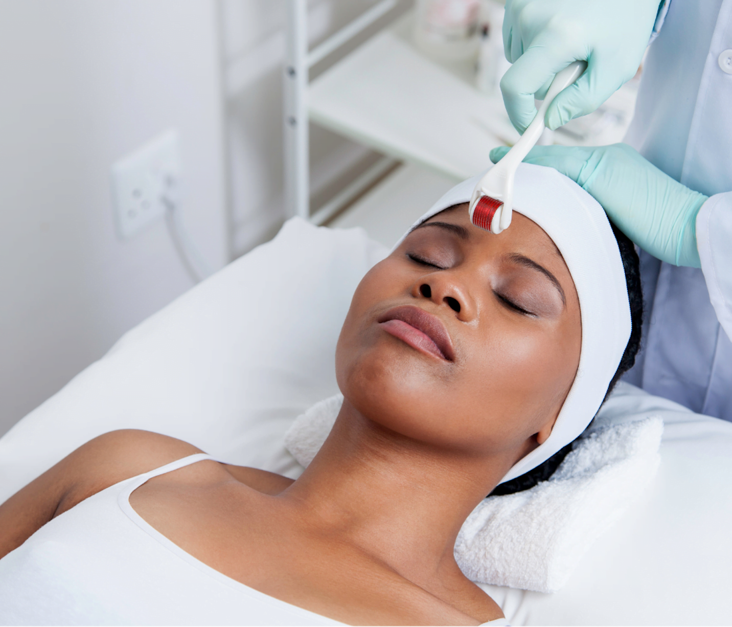 How microneedling helps acne? Skin Perfection London