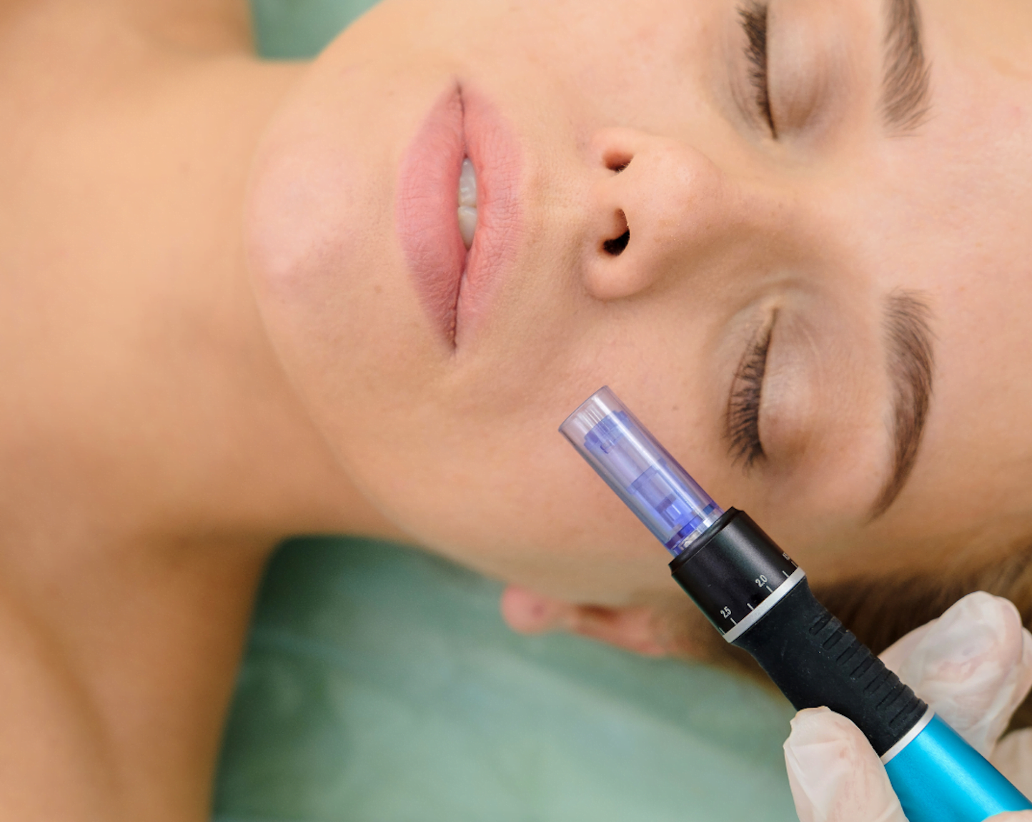 What microneedling does?