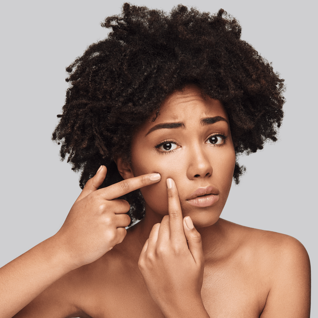 Can you get acne with PCOS?