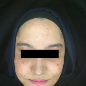 Acne, acne scarring, hyperpigmentation, oily skin, cystic acne brekouts, skin peels Skin Perfection London - After 1