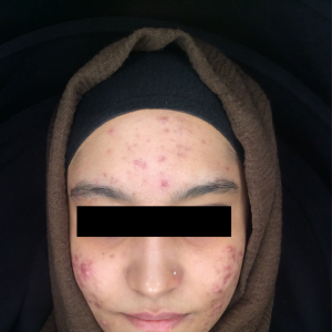 Acne, acne scarring, hyperpigmentation, oily skin, cystic acne brekouts, skin peels Skin Perfection London - Before 1