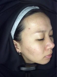 Acne, acne scarring, oily skin, skin peels - Skin Perfection London After 6