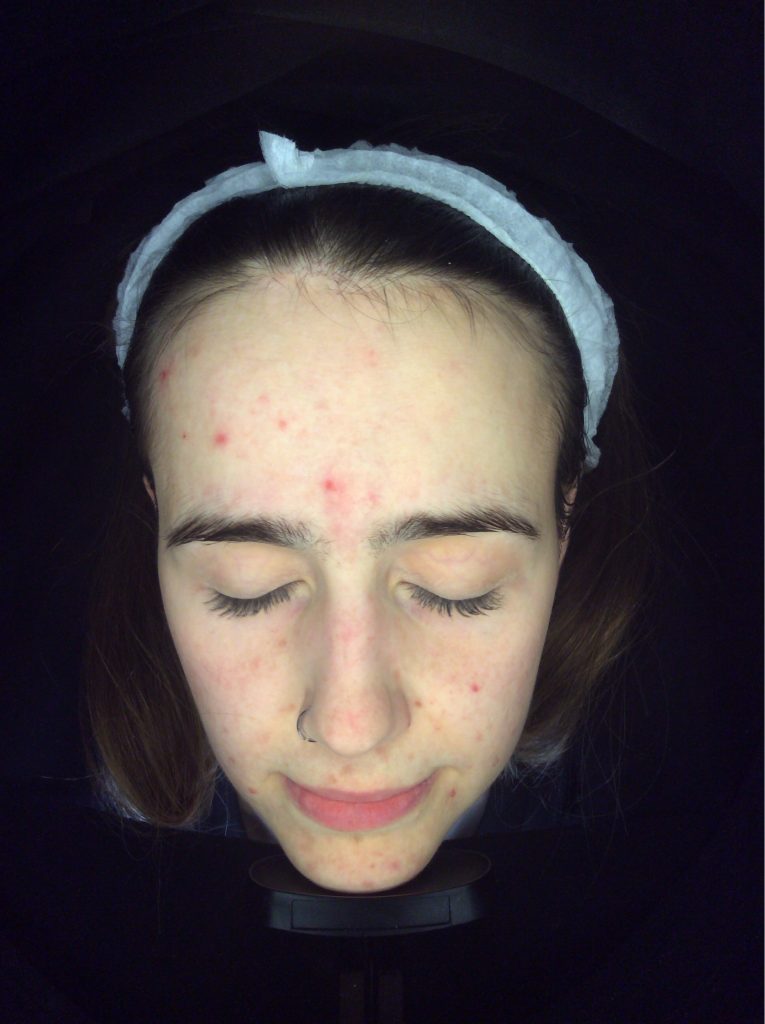 Acne, oily skin, adult acne, skin peels Skin Perfection London After 2