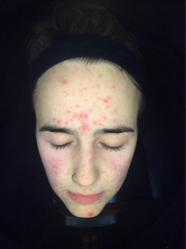 Acne, oily skin, adult acne, skin peels Skin Perfection London Before 2
