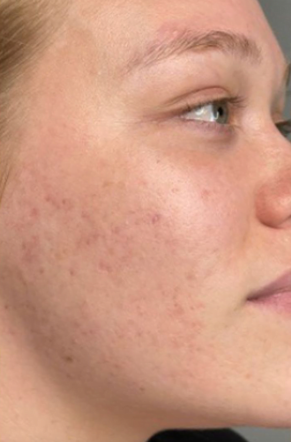 After dermalux led acne
