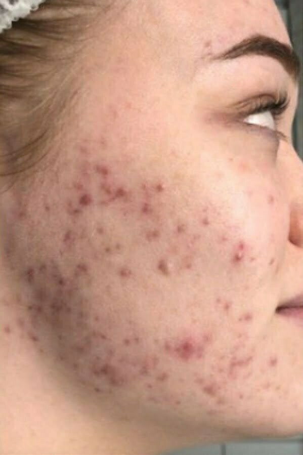 Before dermalux led acne