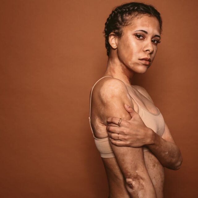 Laser hair removal with vitiligo