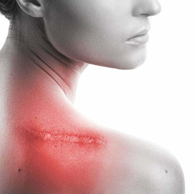 How to remove incision scar?