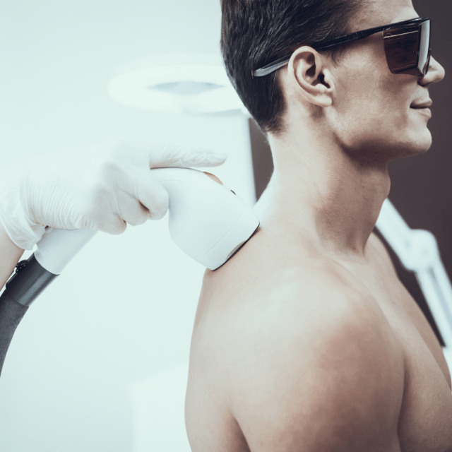 Laser hair removal for men’s back