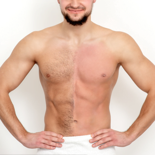 What are the cons of laser hair removal?