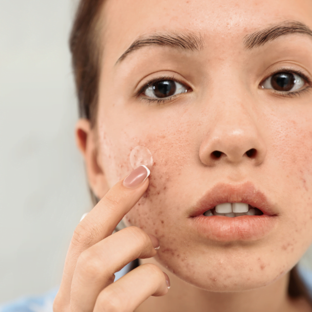 How long a laser burn take to heal?