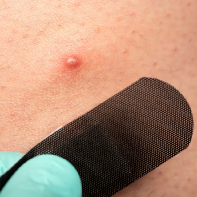 Does laser get rid of deep ingrown hairs?