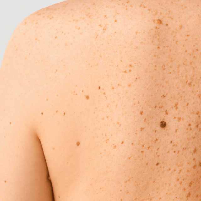 Laser hair removal and moles