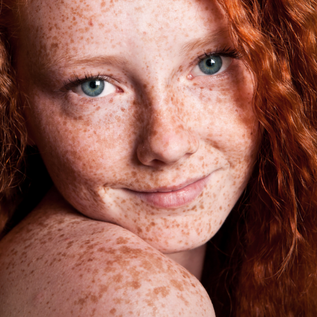 Will laser hair removal work for red hair?