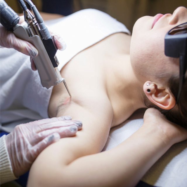 Best laser hair removal in London