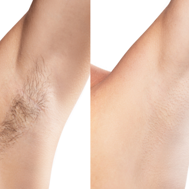 What are the don'ts of laser hair removal?