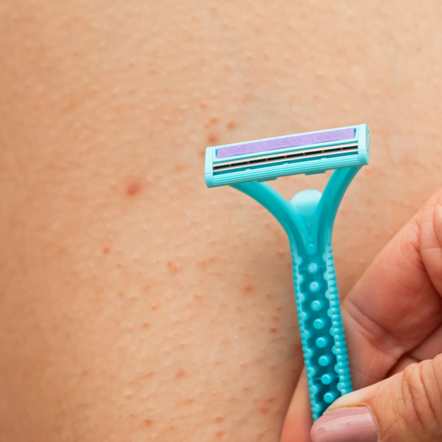 3 reasons why laser hair removal is the best treatment for ingrowing hairs