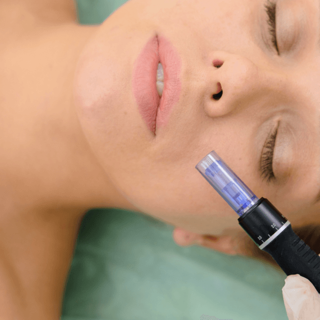 How often do you do dermapen microneedling?