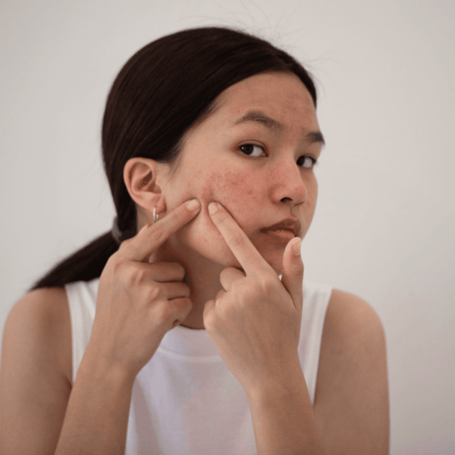 Which treatment is the best for acne?