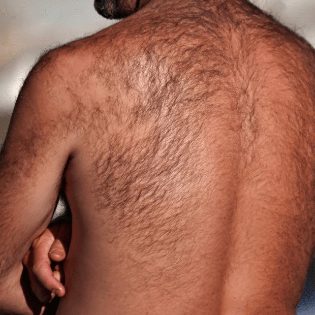 Can you be too hairy for laser hair removal?