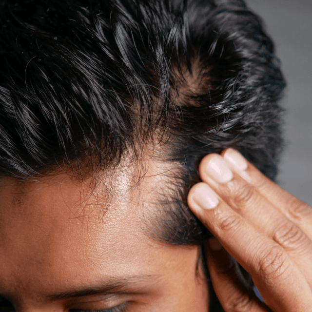 Which hair loss treatment is best for men?