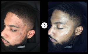 POST ACNE SCARRING TREATMENTS