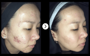 cystic acne