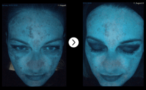 MELASMA TREATMENT skin peels