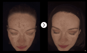 MELASMA skin peels