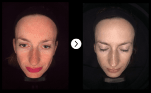 pigmentation and sun damage skin peels