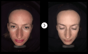 SUNDAMAGE skin peels