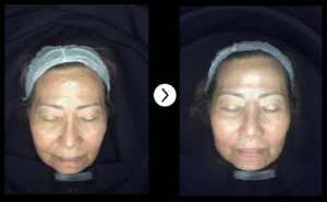 MELASMA, HORMONAL PIGMENTATION