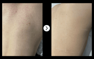 laser back