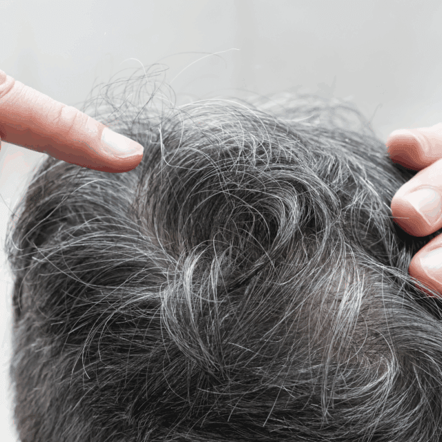What are the best non-surgical treatments for thinning hair?