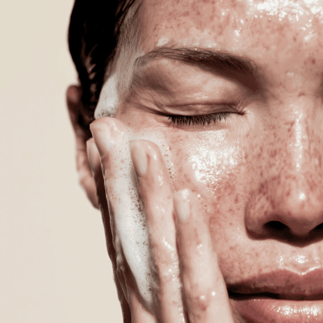 How to prevent new acne scars from forming?
