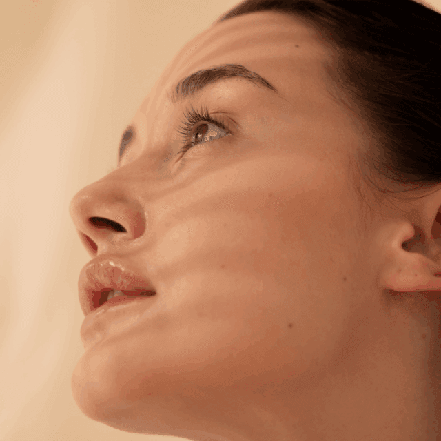 Why is my acne pigmentation not fading?